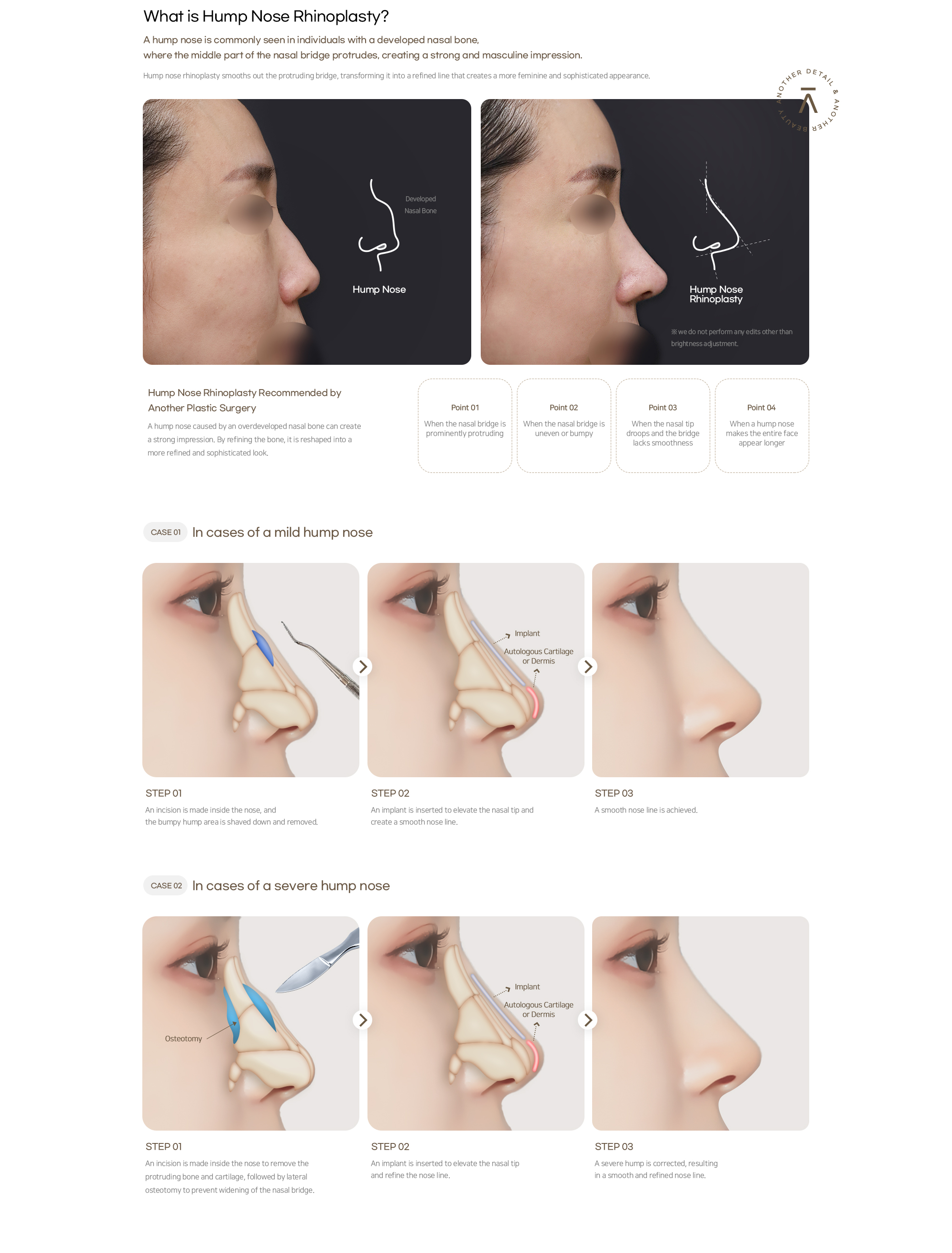 Another Plastic Surgery Hump Nose