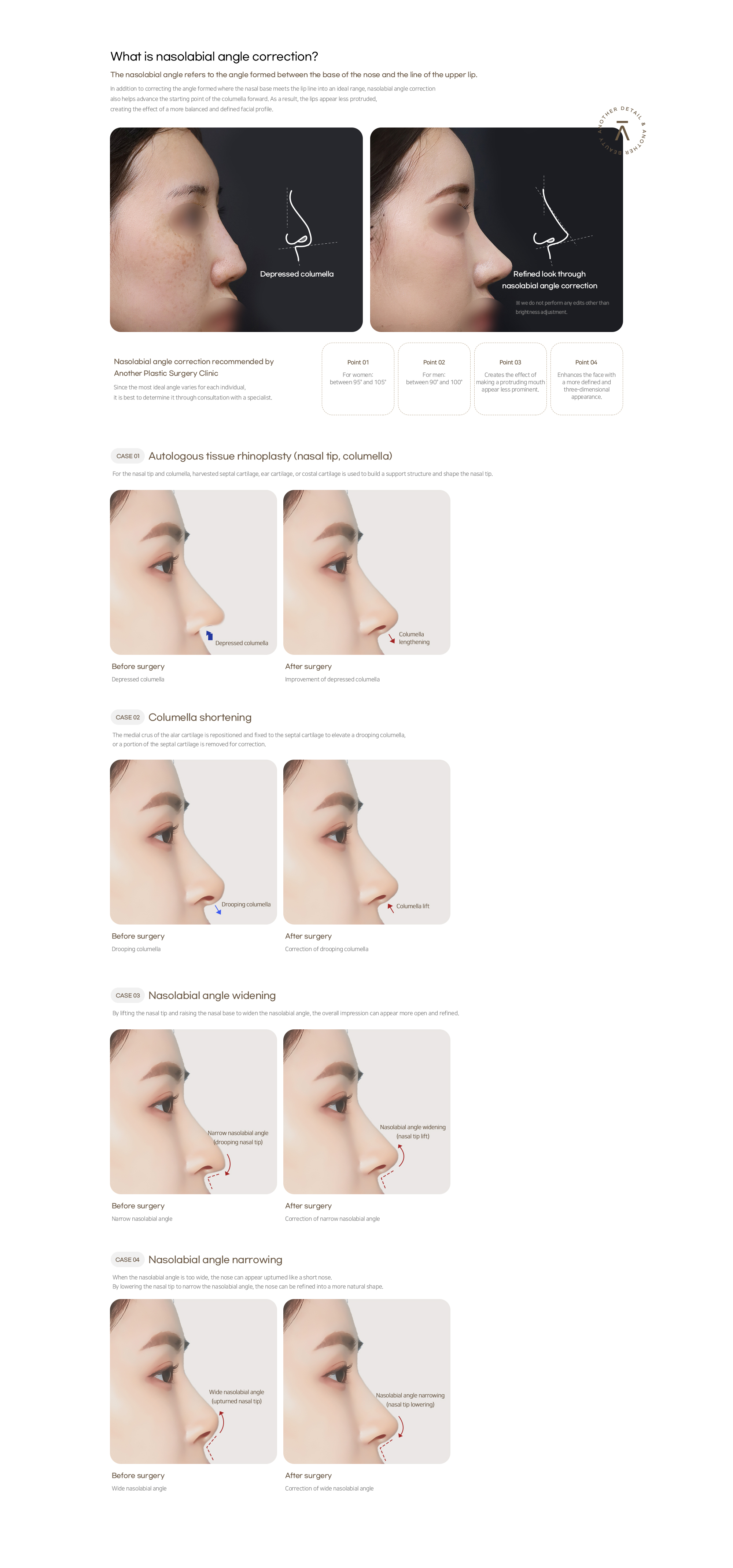 Nasolabial Angle Correction