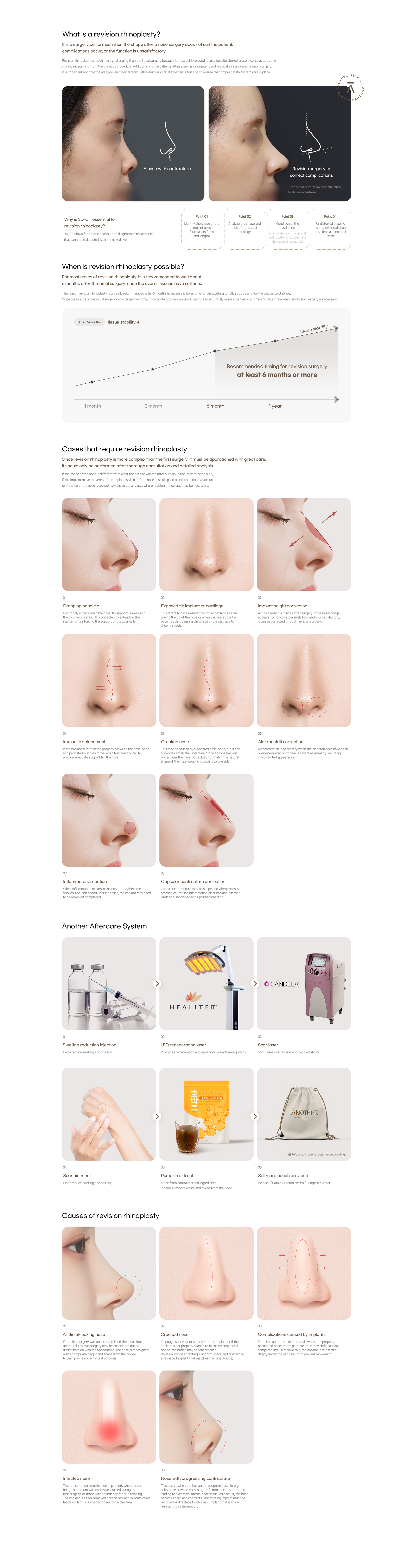 Revision Rhinoplasty