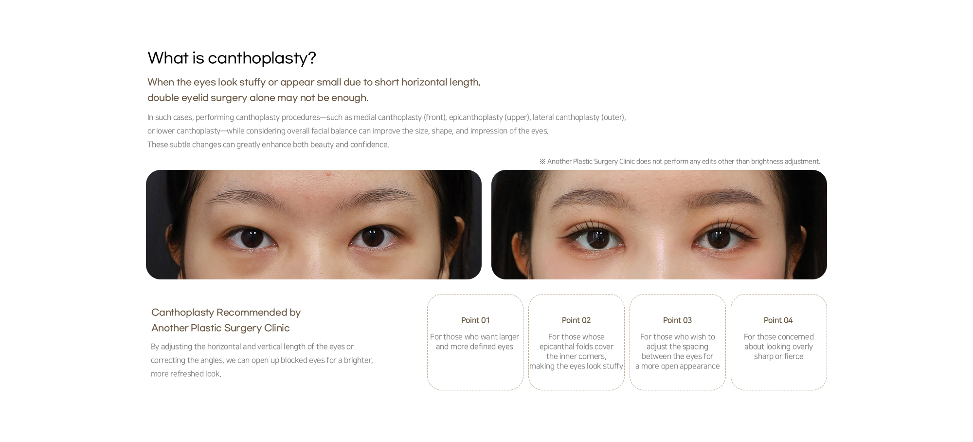Canthoplasty