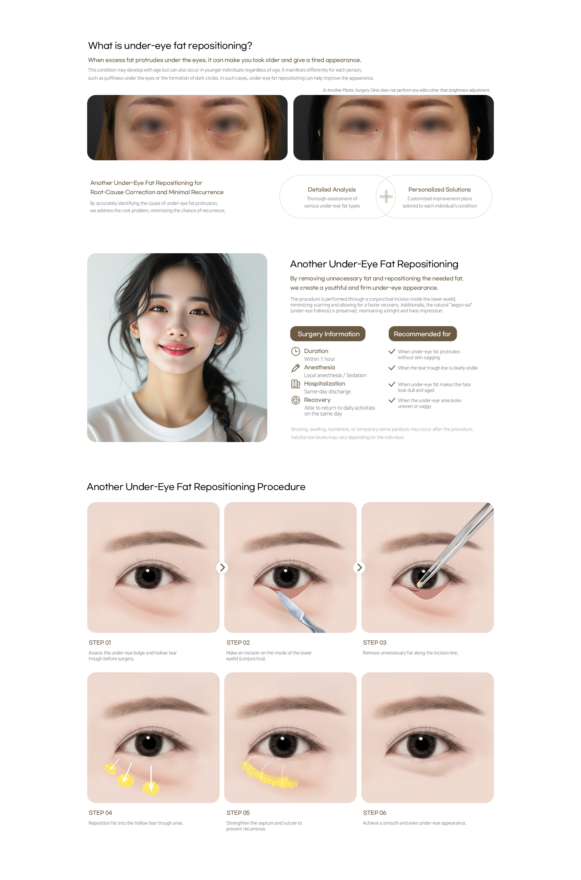 Under-Eye Fat Repositioning