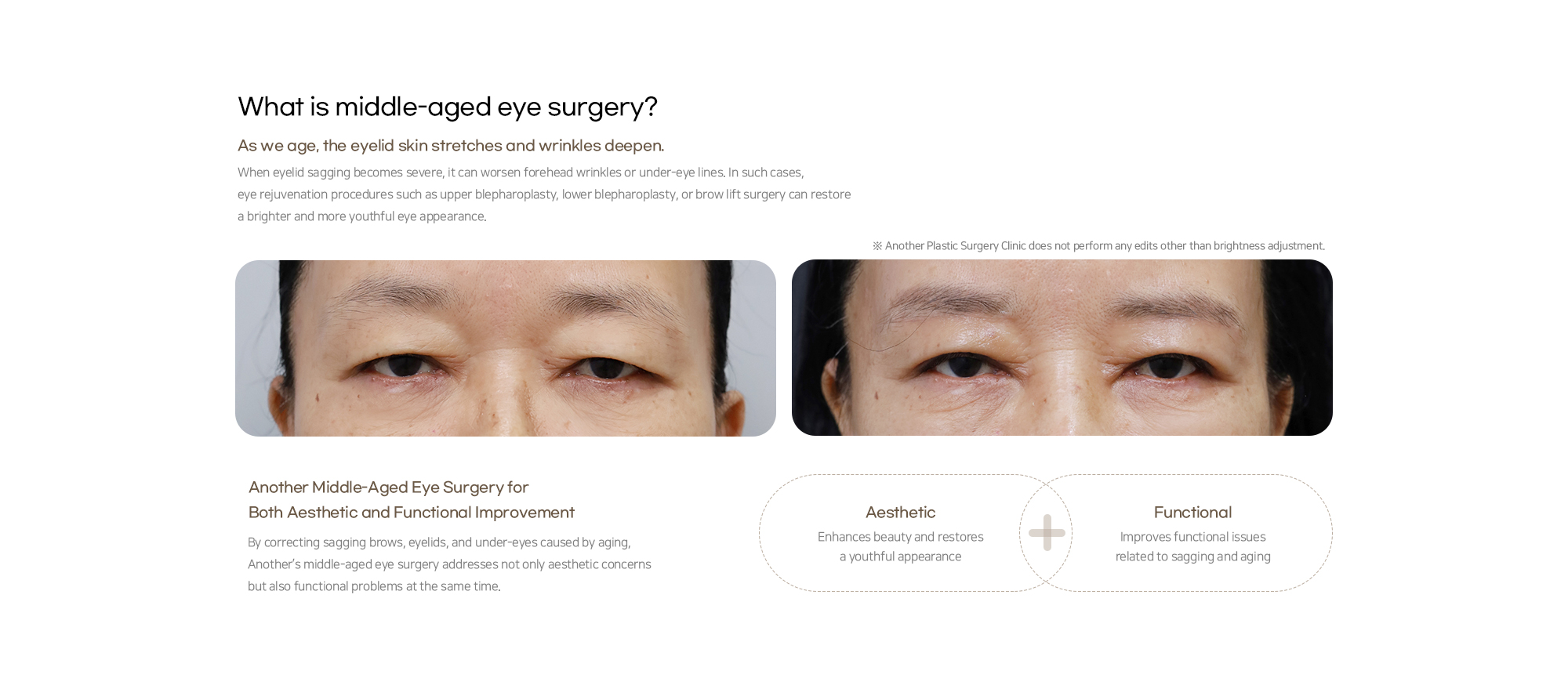 Middle-Aged Eye Surgery