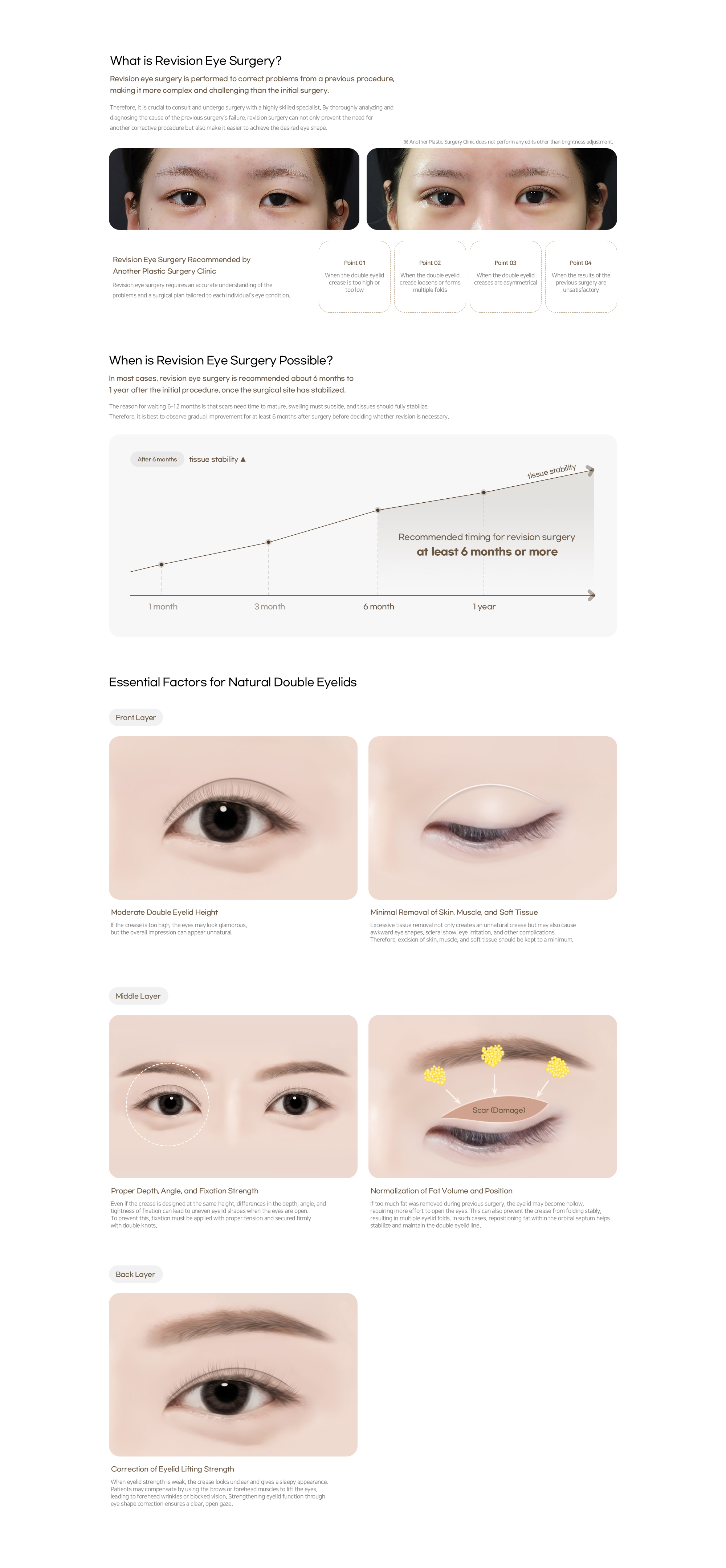 Revision Eye Surgery